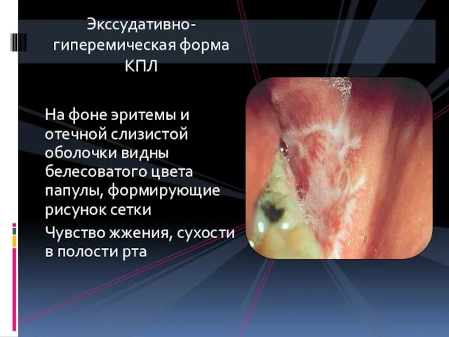 Экссудативно-гиперемическая форма КПЛ На фоне эритемы и отечной слизистой оболочки видны белесоватого