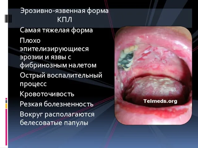 Эрозивно-язвенная форма КПЛ Самая тяжелая форма Плохо эпителизирующиеся эрозии и язвы с