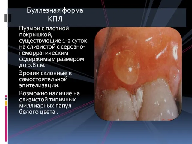 Буллезная форма КПЛ Пузыри с плотной покрышкой, существующие 1-2 суток на слизистой