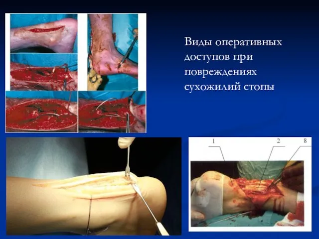 Виды оперативных доступов при повреждениях сухожилий стопы