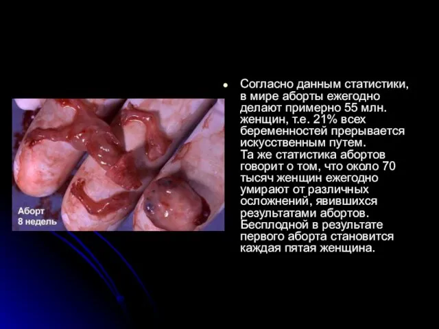 Согласно данным статистики, в мире аборты ежегодно делают примерно 55 млн. женщин,