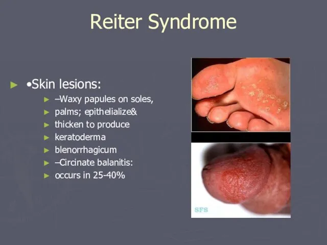 Reiter Syndrome •Skin lesions: –Waxy papules on soles, palms; epithelialize& thicken to