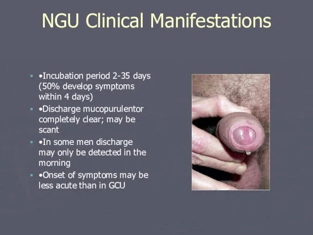 NGU Clinical Manifestations •Incubation period 2-35 days (50% develop symptoms within 4