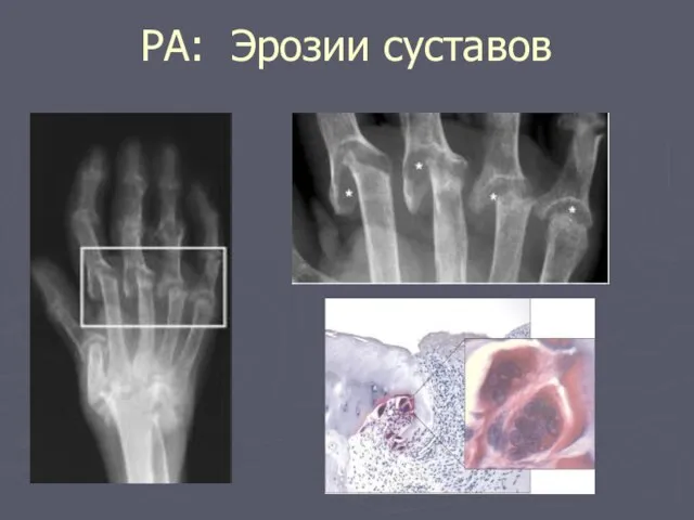 РА: Эрозии суставов