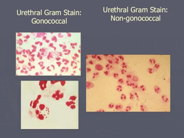 Urethral Gram Stain: Non-gonococcal Urethral Gram Stain: Gonococcal