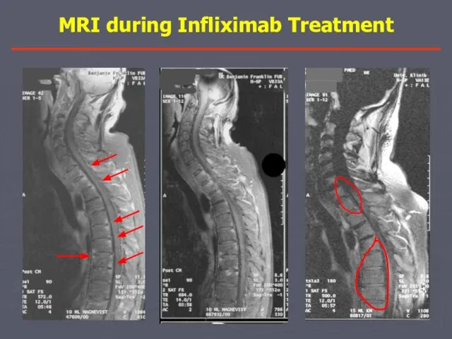 MRI during Infliximab Treatment 0 неделя 12 неделя