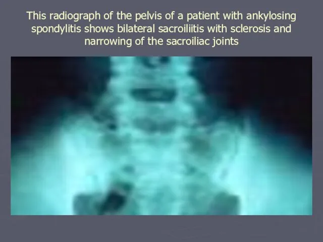 This radiograph of the pelvis of a patient with ankylosing spondylitis shows