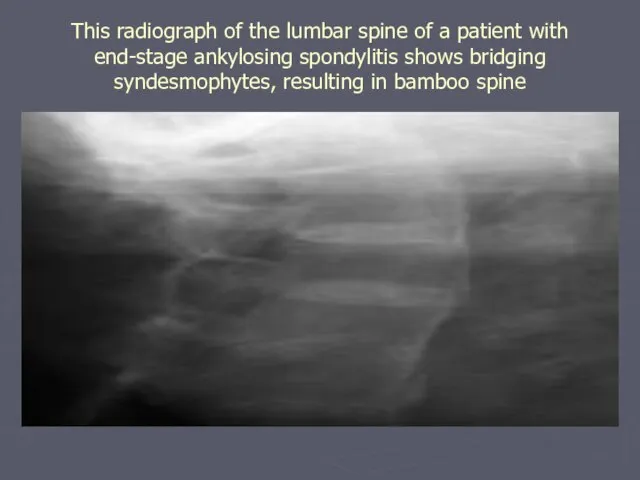 This radiograph of the lumbar spine of a patient with end-stage ankylosing