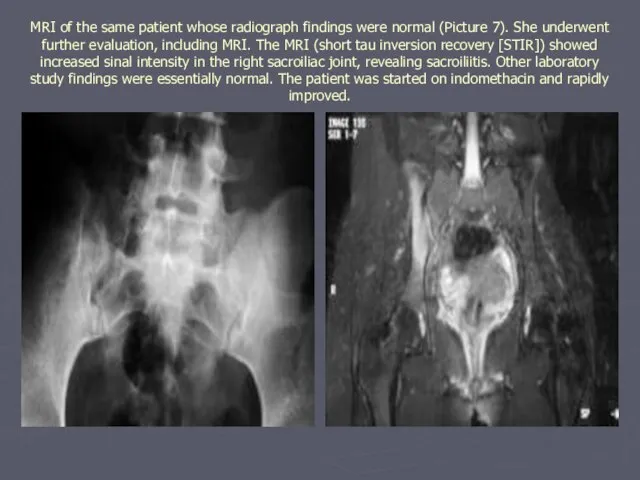 MRI of the same patient whose radiograph findings were normal (Picture 7).