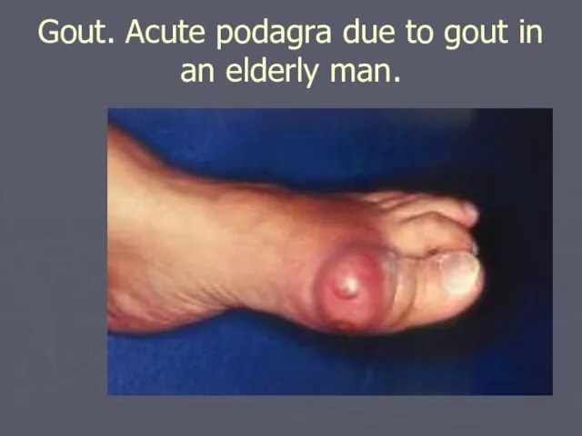 Gout. Acute podagra due to gout in an elderly man.
