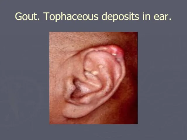 Gout. Tophaceous deposits in ear.