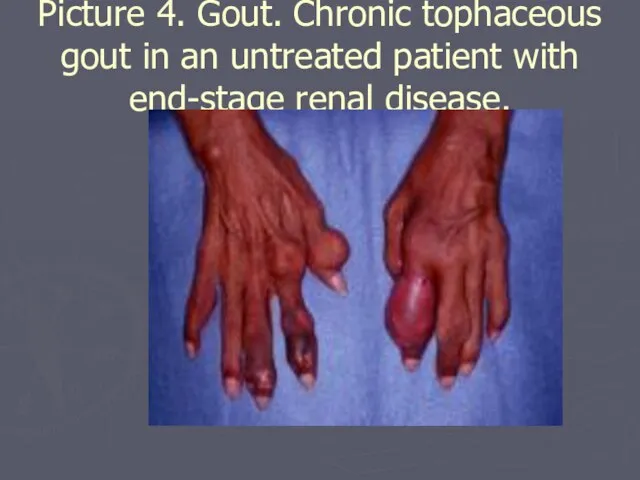 Picture 4. Gout. Chronic tophaceous gout in an untreated patient with end-stage renal disease.