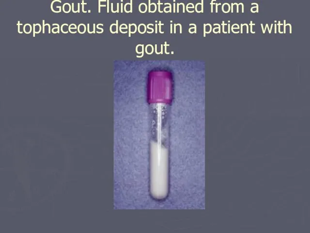 Gout. Fluid obtained from a tophaceous deposit in a patient with gout.