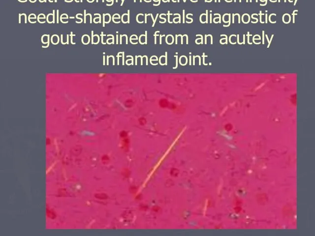 Gout. Strongly negative birefringent, needle-shaped crystals diagnostic of gout obtained from an acutely inflamed joint.