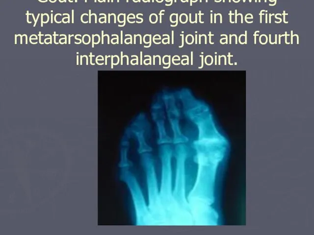 Gout. Plain radiograph showing typical changes of gout in the first metatarsophalangeal