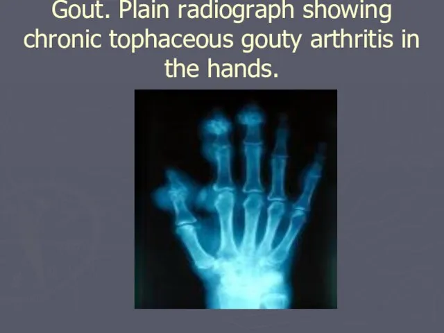 Gout. Plain radiograph showing chronic tophaceous gouty arthritis in the hands.