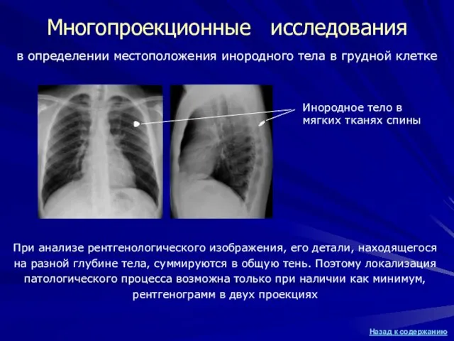 Многопроекционные исследования При анализе рентгенологического изображения, его детали, находящегося на разной глубине