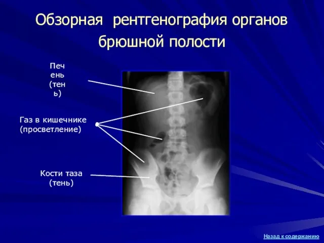 Обзорная рентгенография органов брюшной полости Печень(тень) Кости таза (тень) Газ в кишечнике (просветление)