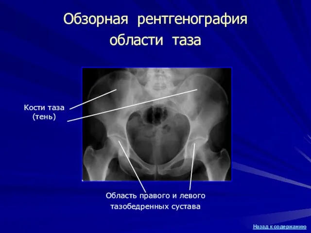 Обзорная рентгенография области таза Кости таза (тень) Область правого и левого тазобедренных сустава