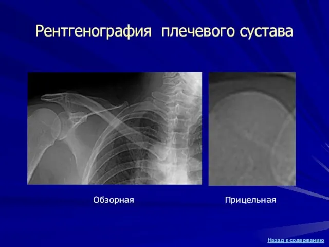 Рентгенография плечевого сустава Прицельная Обзорная