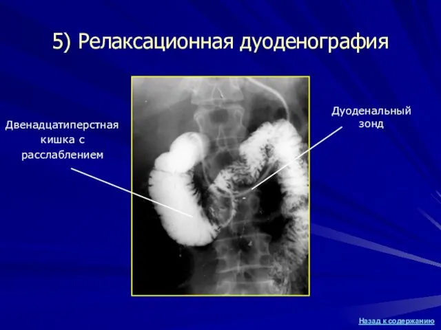 5) Релаксационная дуоденография Дуоденальный зонд Двенадцатиперстная кишка с расслаблением