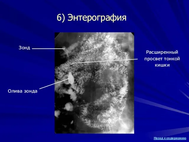 Зонд Олива зонда Расширенный просвет тонкой кишки 6) Энтерография