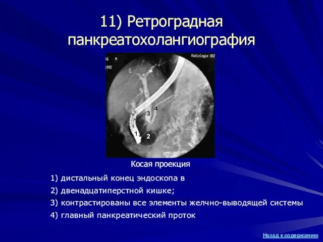 11) Ретроградная панкреатохолангиография 1) дистальный конец эндоскопа в 2) двенадцатиперстной кишке; 3)