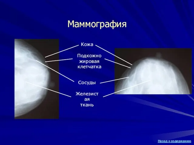 Маммография Кожа Подкожно жировая клетчатка Сосуды Железистая ткань