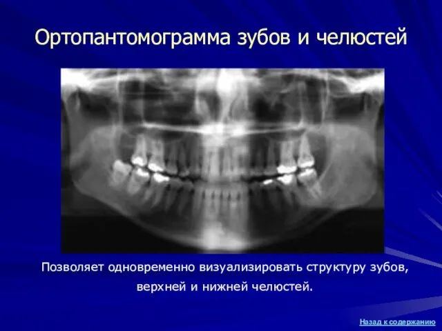 Ортопантомограмма зубов и челюстей Позволяет одновременно визуализировать структуру зубов, верхней и нижней челюстей.