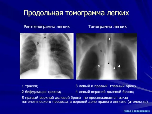Продольная томограмма легких Рентгенограмма легких Томограмма легких 1 трахея; 2 бифуркация трахеи;