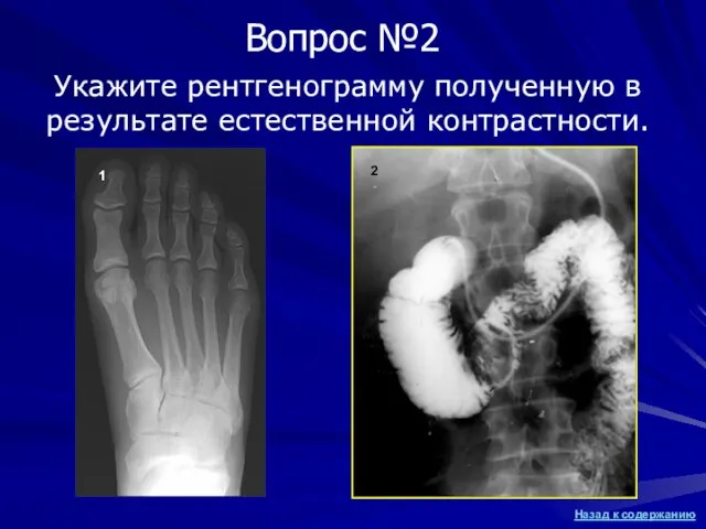Укажите рентгенограмму полученную в результате естественной контрастности. 1 2 Вопрос №2