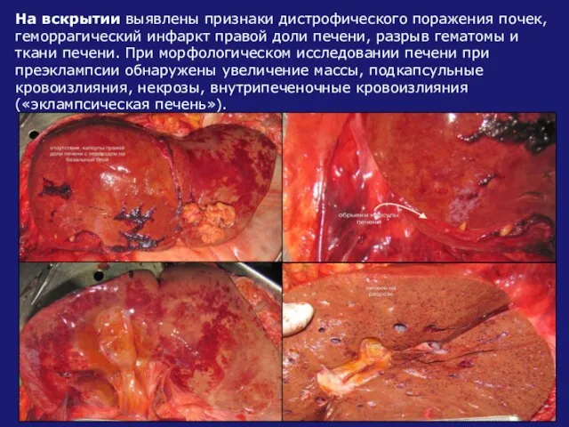 На вскрытии выявлены признаки дистрофического поражения почек, геморрагический инфаркт правой доли печени,