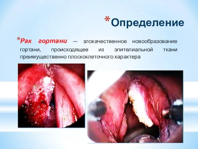 Определение Рак гортани — злокачественное новообразование гортани, происходящее из эпителиальной ткани преимущественно плоскоклеточного характера