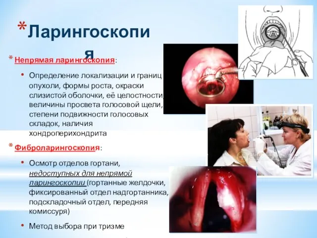 Ларингоскопия Непрямая ларингоскопия: Определение локализации и границ опухоли, формы роста, окраски слизистой