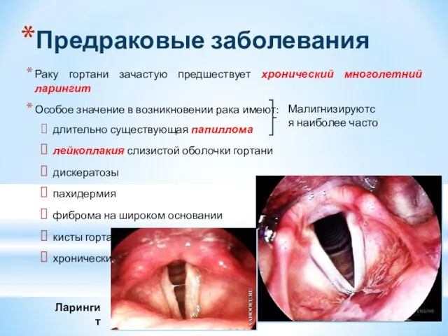 Предраковые заболевания Раку гортани зачастую предшествует хронический многолетний ларингит Особое значение в