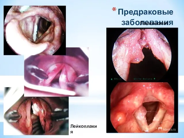 Предраковые заболевания Лейкоплакия Папилломатоз