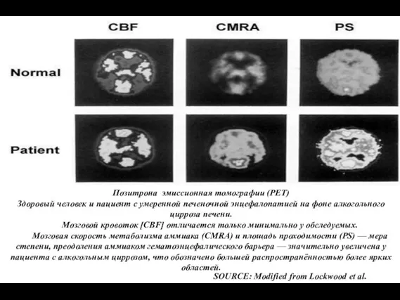 SOURCE: Modified from Lockwood et al. 1991. Позитрона эмиссионная томографии (PET) Здоровый