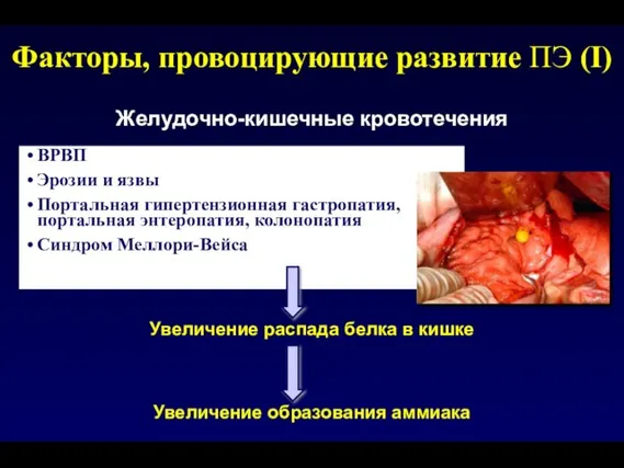 Факторы, провоцирующие развитие ПЭ (I) Желудочно-кишечные кровотечения ВРВП Эрозии и язвы Портальная