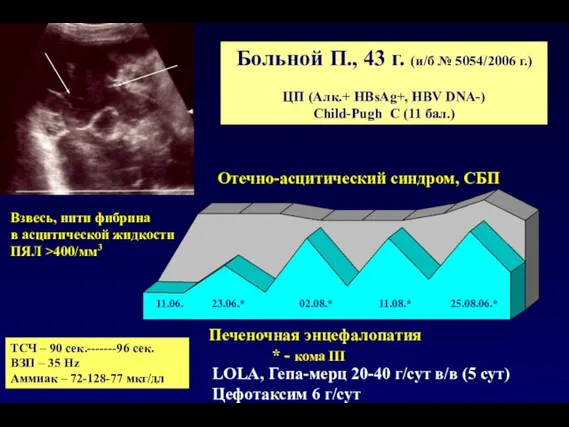 Больной П., 43 г. (и/б № 5054/2006 г.) ЦП (Алк.+ HBsAg+, HBV