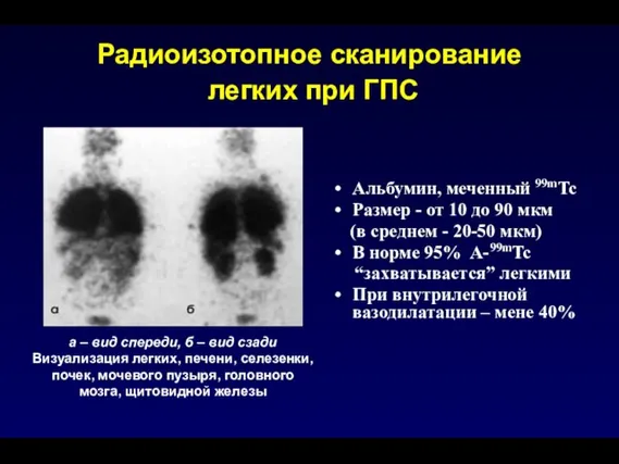 Радиоизотопное сканирование легких при ГПС Альбумин, меченный 99mTc Размер - от 10
