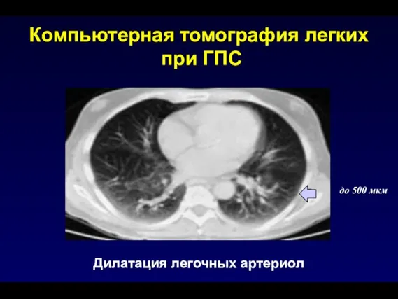 Компьютерная томография легких при ГПС Дилатация легочных артериол до 500 мкм