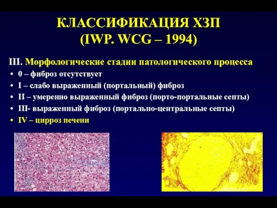 КЛАССИФИКАЦИЯ ХЗП (IWP. WCG – 1994) III. Морфологические стадии патологического процесса 0