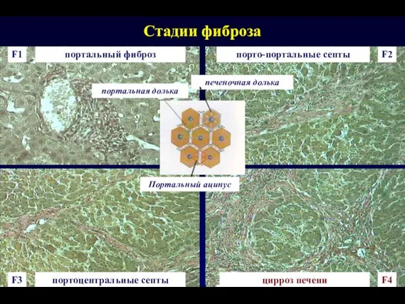 Стадии фиброза F1 F2 F3 F4 портальный фиброз порто-портальные септы портоцентральные септы