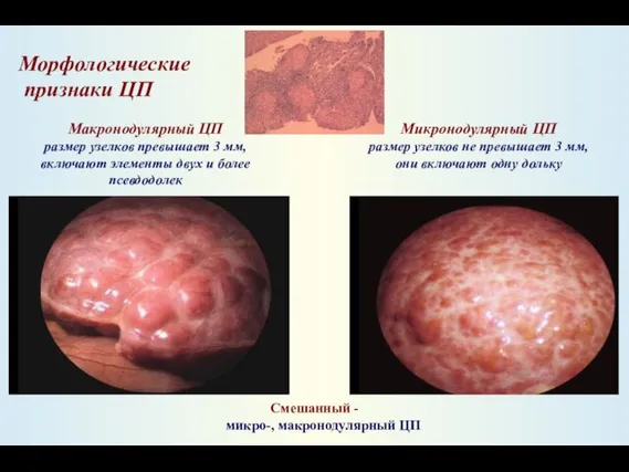 Морфологические признаки ЦП Микронодулярный ЦП размер узелков не превышает 3 мм, они