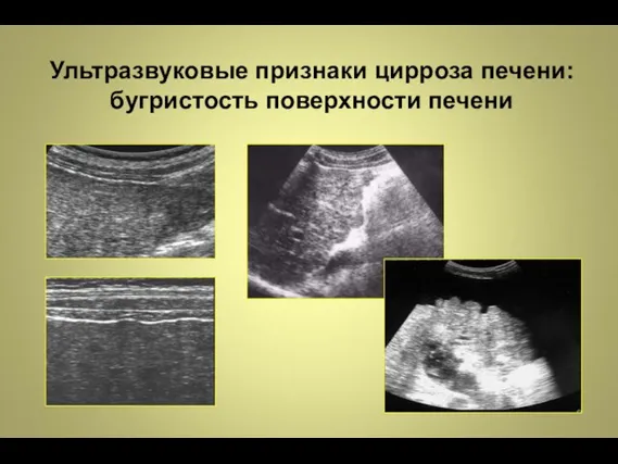 Ультразвуковые признаки цирроза печени: бугристость поверхности печени