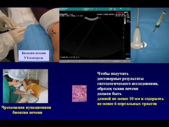 Биопсия печени УЗ-контроль Чтобы получить достоверные результаты гистологического исследования, образец ткани печени