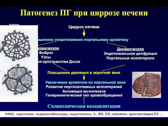 Патогенез ПГ при циррозе печени Цирроз печени Повышенное сопротивление портальному кровотоку Механическое