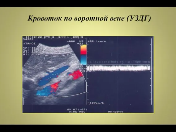 Кровоток по воротной вене (УЗДГ)