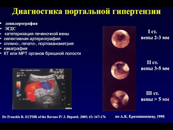 Диагностика портальной гипертензии допплерография ЭГДС катетеризация печеночной вены селективная артериография сплено-, гепато-,