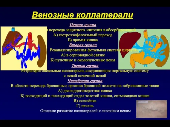 Венозные коллатерали Первая группа В области перехода защитного эпителия в абсорбирующий А)